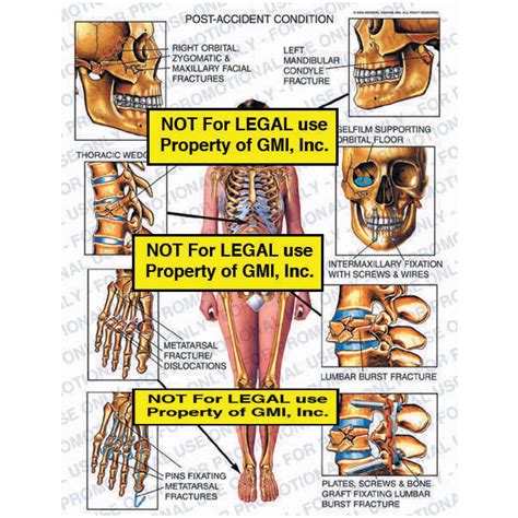 Post Accident Condition 00194a Generic Medical Legal Exhibits A Division Of Mvi