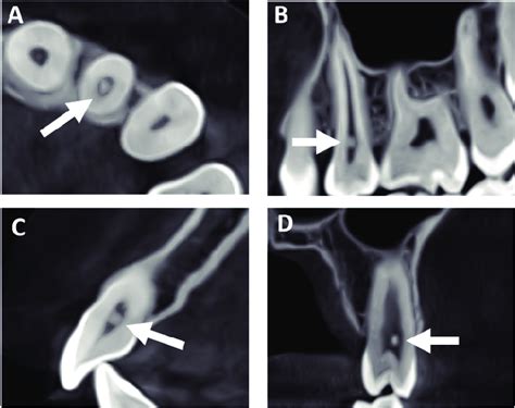 Axial A Sagittal B And C And Coronal D CBCT Views Showing Pulp