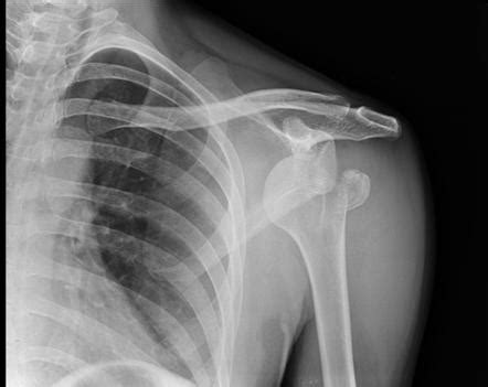 Anterior Shoulder Dislocation With Fracture Of Greater Tuberosity Of