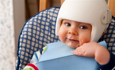 Brachycephaly And Plagiocephaly Symptoms And Treatment