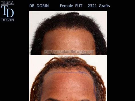 Dr Robert Dorin Female Hair Restoration Procedure Before And After