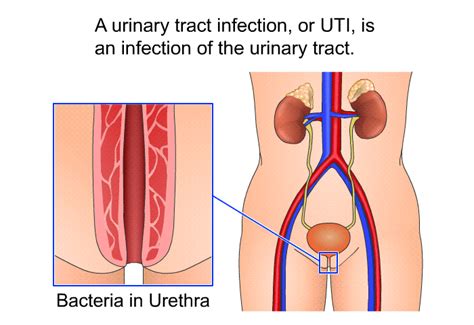 PatEdu UTIs In Elderly Adults