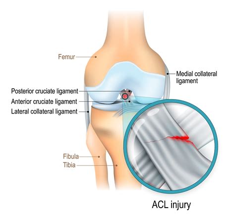 Anterior Cruciate Ligament Acl