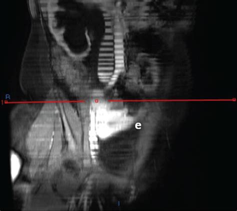 Pelvic Magnetic Resonance Imaging Showing The Following A Sagittal