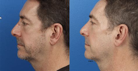 Male Jaw Implant Before And After