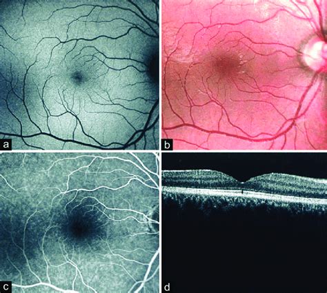 A Fundus Autofluorescence B Fundus Photography C Fluorescein