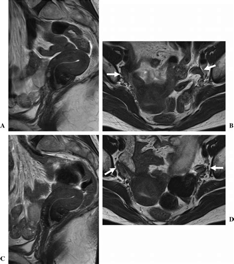 A 58 Year Old Postmenopausal Woman With Uterine Cervical Cancer Treated