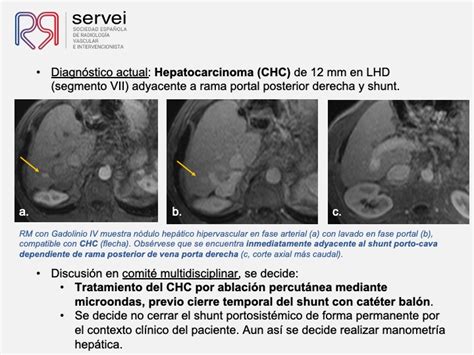 Ablación del hepatocarcinoma mediante microondas previo cierre temporal