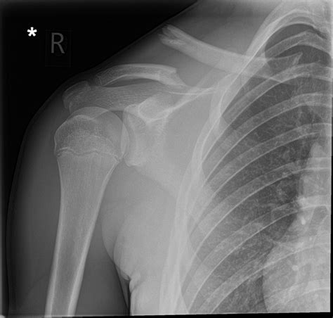 Normal Clavicle Xray