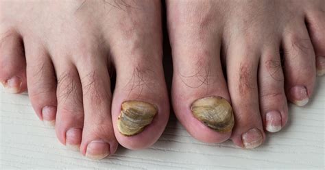 Infections/Toenail Fungus | STD Concern