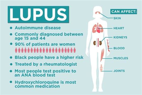 Fakty O Toczniu Things To Know About Lupus Trend Repository