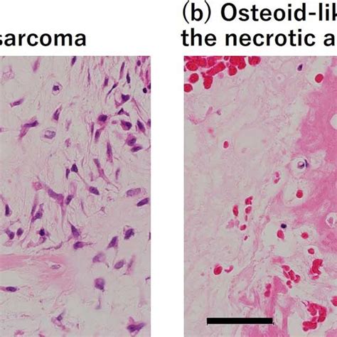 Preoperative Biopsy Specimen Showed High Grade Sarcoma Mainly With