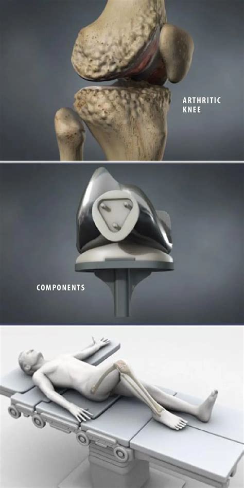 Total Knee Replacement | Orthopedic Surgery & Joint Replacement located