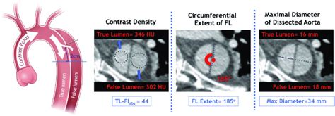 Primary Baseline Computed Tomography Angiography Measurements Download Scientific Diagram