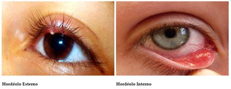 Hordeolo E Calazio Diferença - Hordeolo Interno Da Palpebra Superior Resumo De Hordéolo: