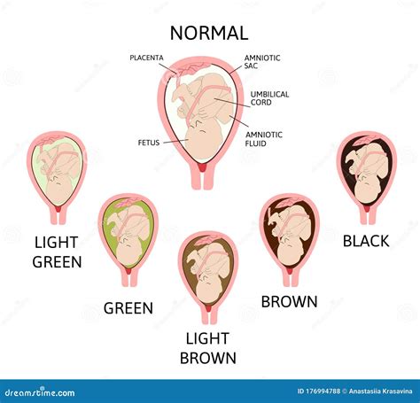 Color of Amniotic Fluid in the Amniotic Sac. Normal and Danger Variants ...