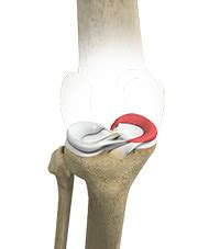 Medial Meniscus Syndrome Tears Dedham WA Arthroscopic Repair