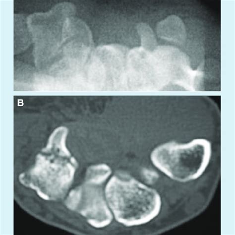 A Triquetral Fracture This Is The Most Common Variant Of Triquetral Download Scientific