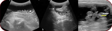 A Longitudinal Sonogram Of Left Popliteal Fossa Demonstrates Cystic