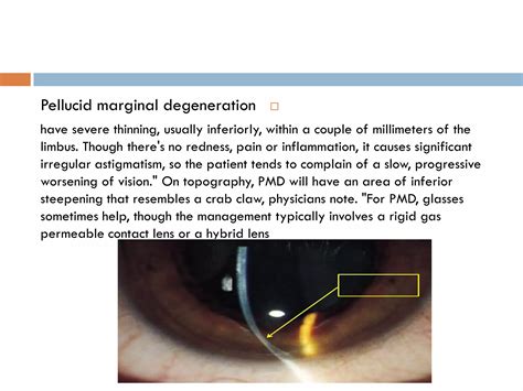 Peripheral Ulcerative Keratitis Puk Ppt