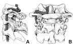 Knowning Is Doing High Riding Vertebral Artery