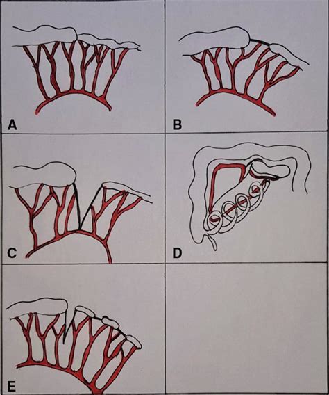 classification  jejuno ileal atresia  type   type   type