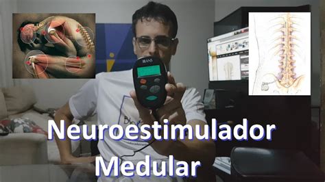 Neuroestimulador Medular YouTube