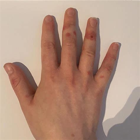 Frontiers How To Deal With Post Viral Cutaneous Eruptions In The Era