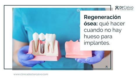 Cómo restaurar la salud bucal a través de la regeneración ósea Blog