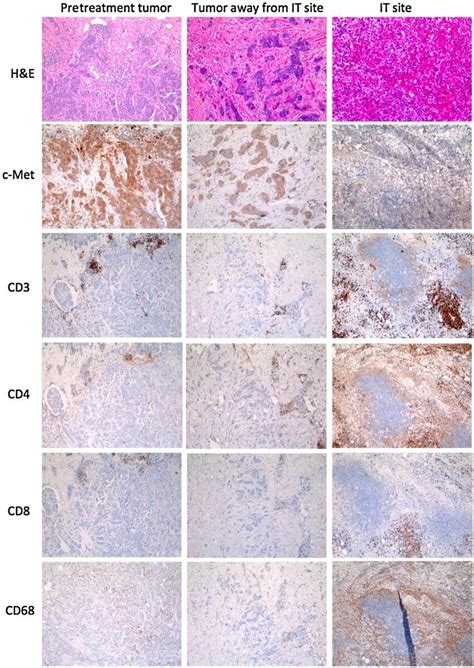 Histology and IHC of tumor tissue preand postintratumoral injection of ...