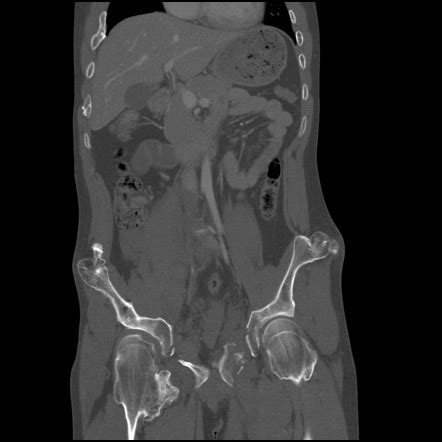 Hereditary Multiple Exostoses HME And Pelvic Trauma Image