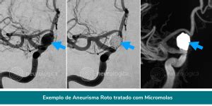 Aneurisma Cerebral Preven O Diagn Stico E Tratamento