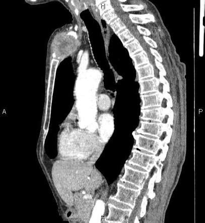 Chest Wall Osteosarcoma Image Radiopaedia Org