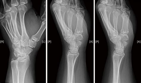 X Ray Of Patients Left Hand In Three Planes Showing Signs Of Basal