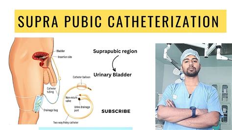 Spc Or Supra Pubic Catheterization Why Need Of Spc Medicaledutech