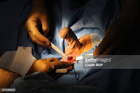 Phalloplasty Step 1 Photos and Premium High Res Pictures - Getty Images