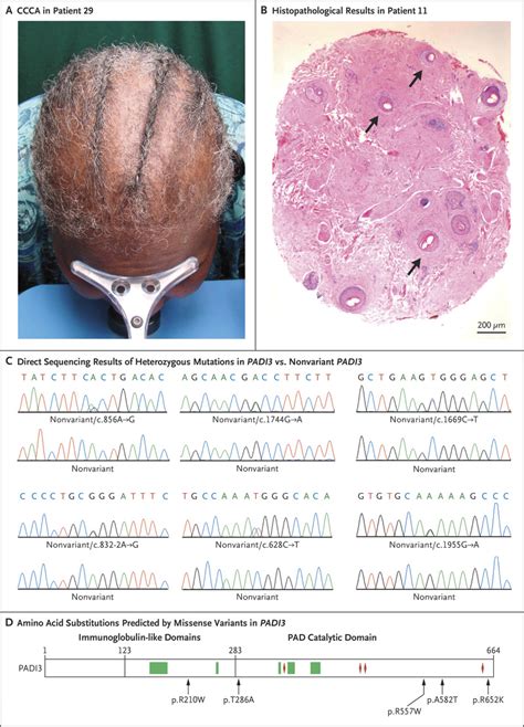 Variant PADI3 in Central Centrifugal Cicatricial Alopecia – SAF – Scarring Alopecia Foundation