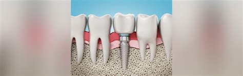 Dental Implants Explained How They Work The Benefits