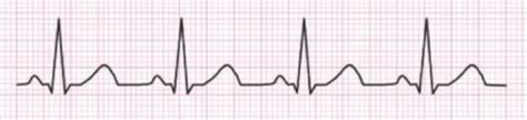 EKG Exam Prep Flashcards Quizlet