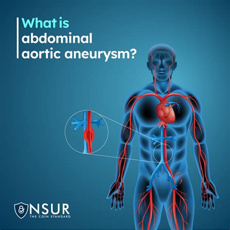 What Is an Abdominal Aortic Aneurysm? – NSUR Blog