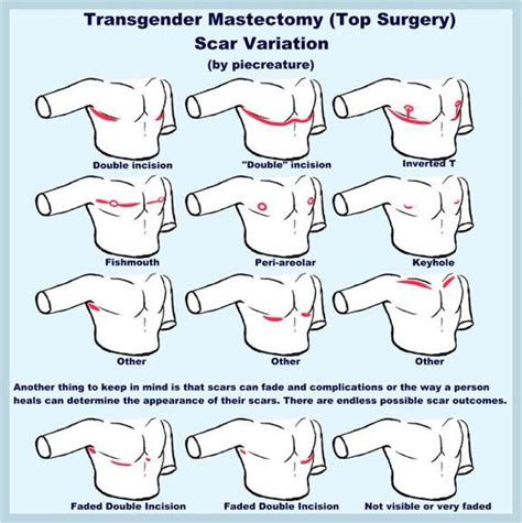 Art Of Top Surgery Scars Rftm