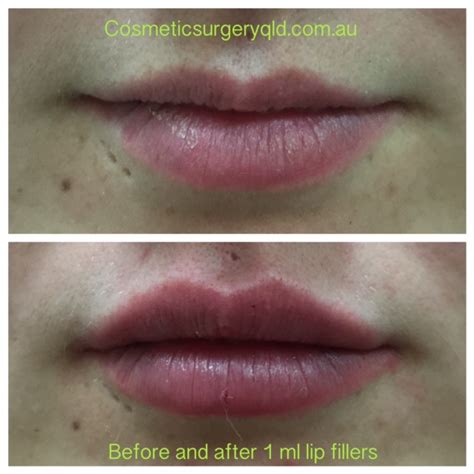 List 99 Pictures Vascular Occlusion Lip Filler Pictures Superb