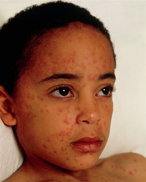 Chickenpox On The Face Of A Young Boy Photograph By Science Photo Library