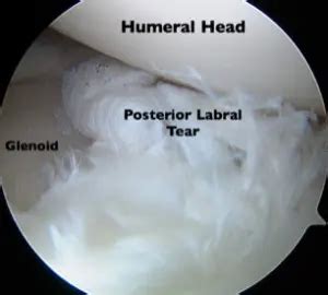 Labrum Tear Town Center Orthopaedics