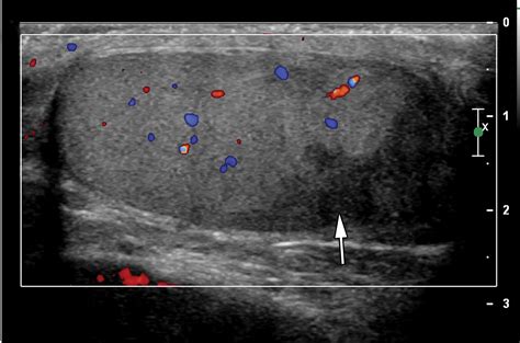 Testicular Seminoma And Its Mimics From The Radiologic Pathology