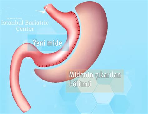 Tüp Mide Ameliyatı ve 2022 Fiyatları Op Dr Murat Üstün