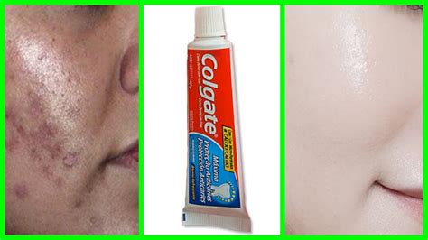 Creme Dental Limpa A Pele Acne E Tira As Manchas Em Dias Se Us