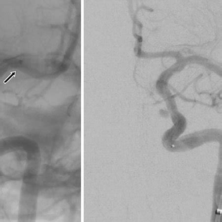 Frontal Projections Of Left Internal Carotid Artery Digital Subtraction