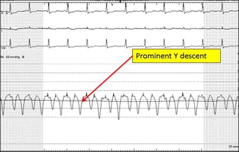 Constrictive Pericarditis Following Heart Transplant American College