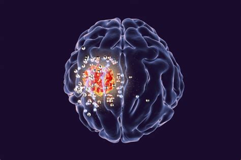 AMPED-UP RADIOTHERAPY FOR BRAIN TUMORS – Kmh Health blog